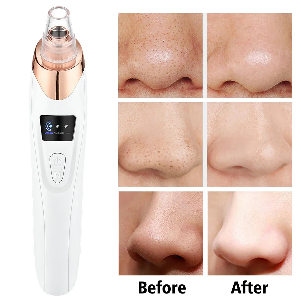 Acne Pore Cleaner & Black Head Remover With Cleaning Tools